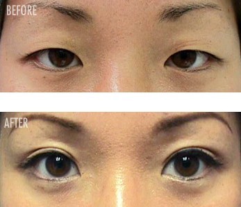   on Asian Double Eyelid Surgery   Abagond